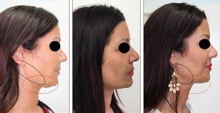 Mesobotox or Microbotox Treatment - SKINFUDGE Aesthetics | Painless, No Side Effects, Natural Looking Results