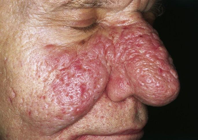 Sebaceous Hyperplasia-SKINFUDGE