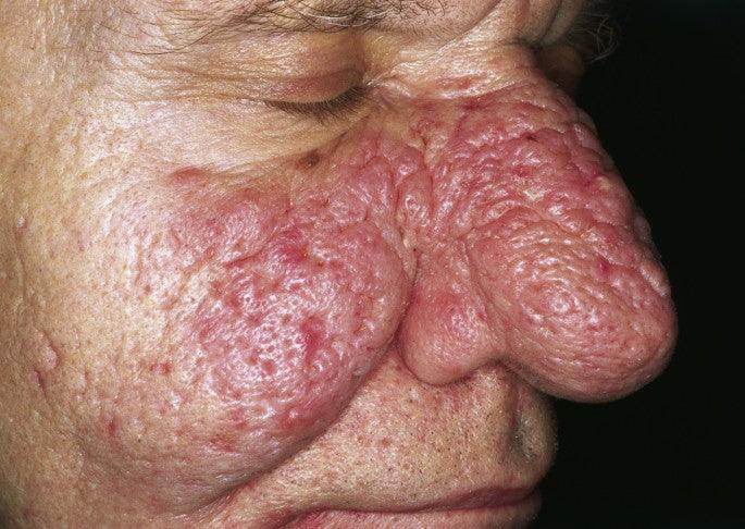Sebaceous Hyperplasia - SKINFUDGE Aesthetics | Painless, No Side Effects, Natural Looking Results