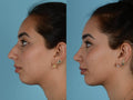 Cosmetic Rhinoplasty (Nose Reshaping Surgery) - SKINFUDGE Aesthetics | Painless, No Side Effects, Natural Looking Results