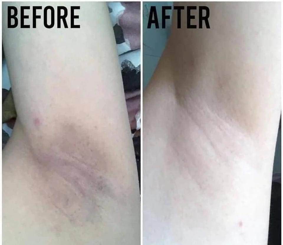 Underarm Whitening Treatment - SKINFUDGE Aesthetics | Painless, No Side Effects, Natural Looking Results