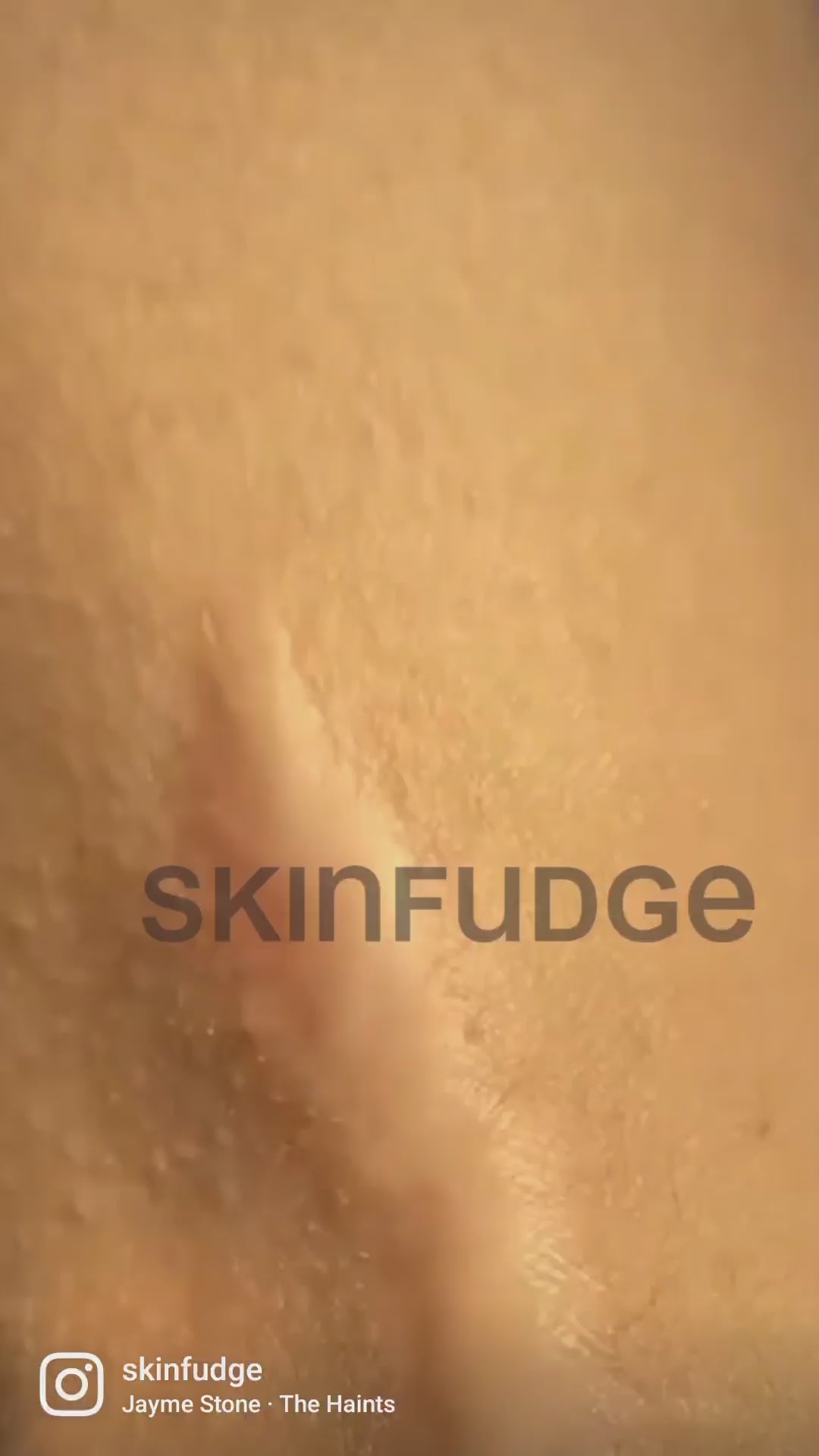 Self-Harm, Injury Marks Arm Scar Treatment with Fotona CO2 Laser