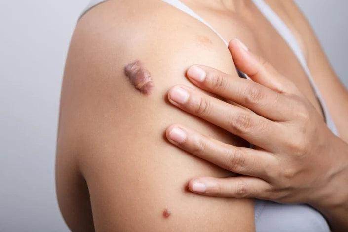 Keloid Treatment Options - SKINFUDGE Aesthetics | Painless, No Side Effects, Natural Looking Results