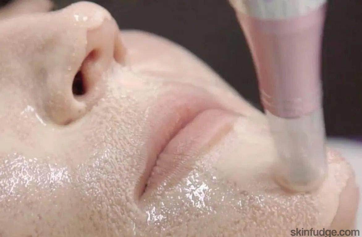 BB Glow Facial (Semi Permanent) - SKINFUDGE Aesthetics | Painless, No Side Effects, Natural Looking Results