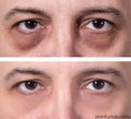 Dark Circle Treatment - SKINFUDGE Aesthetics | Painless, No Side Effects, Natural Looking Results