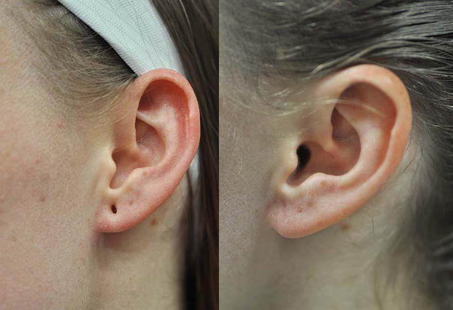 Earlobe Reduction | Earlobe Correction - SKINFUDGE Aesthetics | Painless, No Side Effects, Natural Looking Results