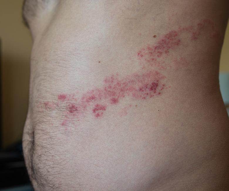 Herpes Zoster (Shingles) Treatment - SKINFUDGE Aesthetics | Painless, No Side Effects, Natural Looking Results