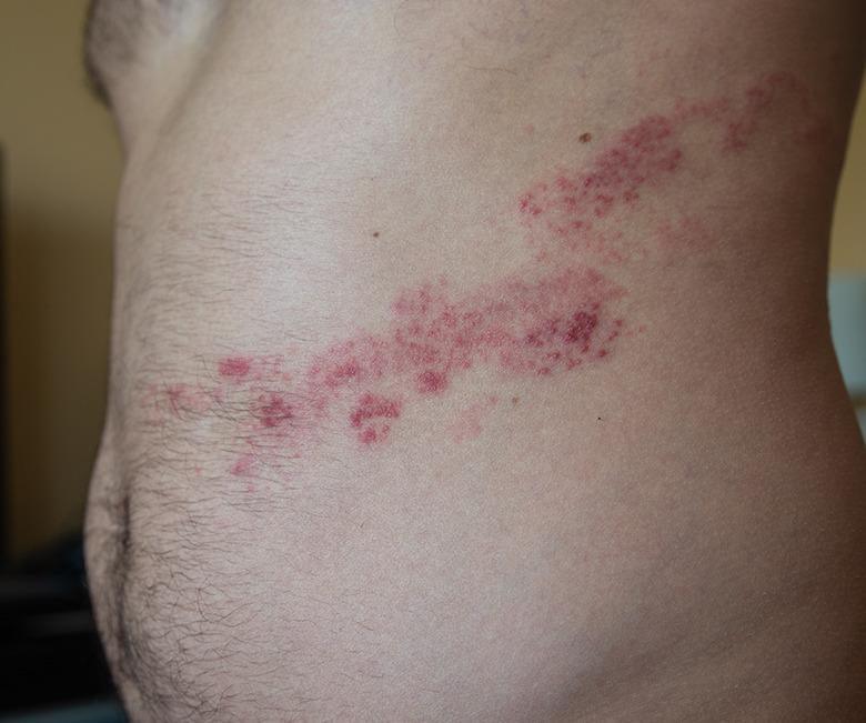 Herpes Zoster (Shingles) Treatment-SKINFUDGE