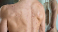 Back Acne Treatment - SKINFUDGE Aesthetics | Painless, No Side Effects, Natural Looking Results