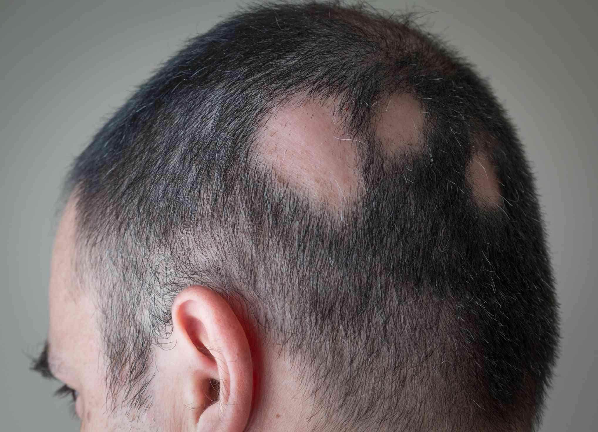 Alopecia Areata Treatment - SKINFUDGE Aesthetics | Painless, No Side Effects, Natural Looking Results