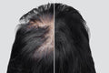 Hair Treatment in Lahore - SKINFUDGE Aesthetics | Painless, No Side Effects, Natural Looking Results