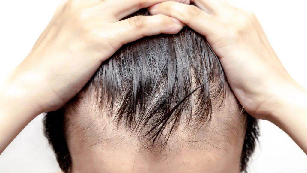 Hairfall Treatment - SKINFUDGE Aesthetics | Painless, No Side Effects, Natural Looking Results