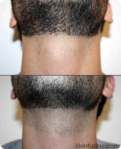 Beard Line Laser Hair Removal - SKINFUDGE Aesthetics | Painless, No Side Effects, Natural Looking Results