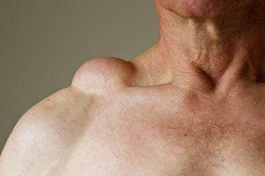 Lipoma Removal - SKINFUDGE Aesthetics | Painless, No Side Effects, Natural Looking Results