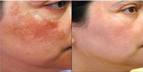 Melasma Laser Treatment-SKINFUDGE