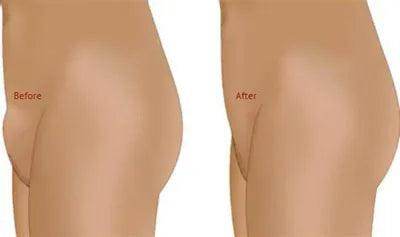 Monsplasty - SKINFUDGE Aesthetics | Painless, No Side Effects, Natural Looking Results