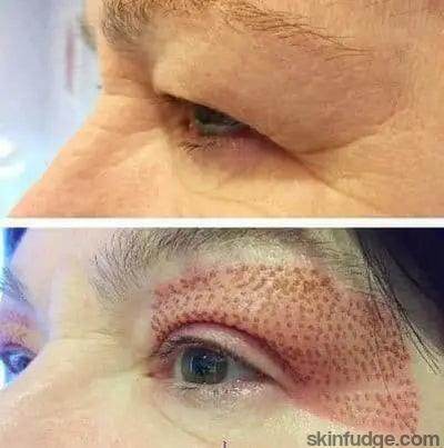 Non-surgical Blephroplasty - SKINFUDGE Aesthetics | Painless, No Side Effects, Natural Looking Results