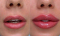 Lip Fillers in Lahore - SKINFUDGE Aesthetics | Painless, No Side Effects, Natural Looking Results