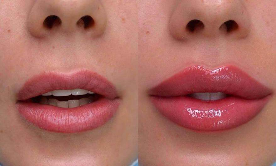 Lip Fillers in Lahore - SKINFUDGE Aesthetics | Painless, No Side Effects, Natural Looking Results