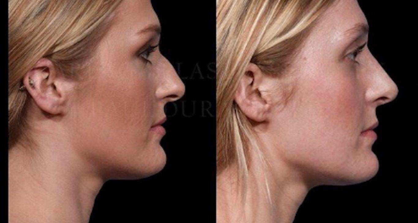 Nonsurgical Rhinoplasty - SKINFUDGE Aesthetics | Painless, No Side Effects, Natural Looking Results