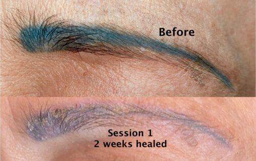 Microblading Laser Removal - SKINFUDGE Aesthetics | Painless, No Side Effects, Natural Looking Results