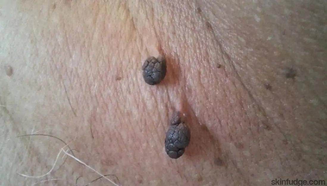 Skin Tag Removal - SKINFUDGE Aesthetics | Painless, No Side Effects, Natural Looking Results