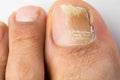 Laser Toe Nail Fungus Removal Treatment - SKINFUDGE Aesthetics | Painless, No Side Effects, Natural Looking Results