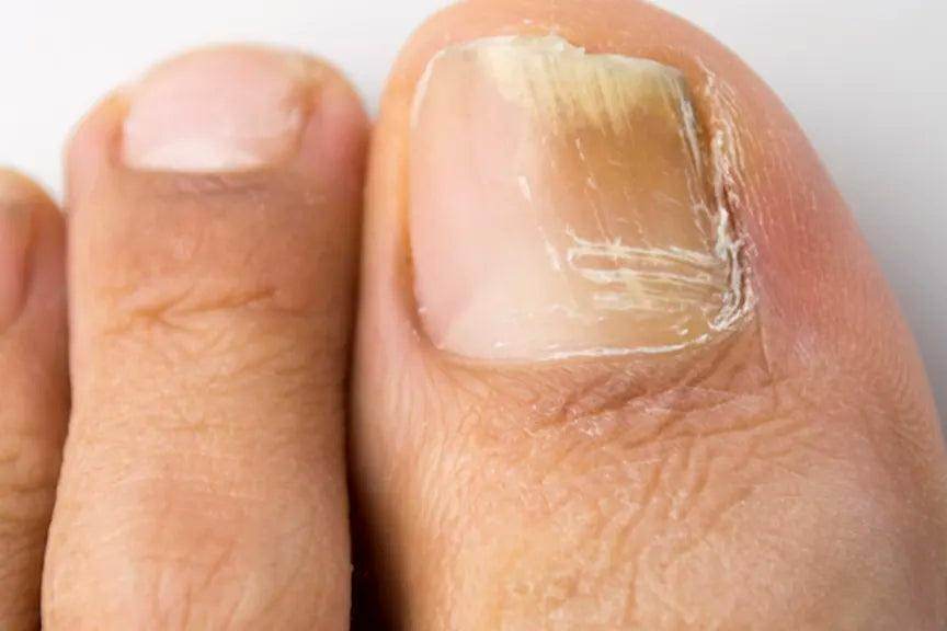 Laser Toe Nail Fungus Removal Treatment - SKINFUDGE Aesthetics | Painless, No Side Effects, Natural Looking Results