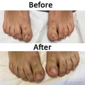 Laser Treatment of Nail Fungus - SKINFUDGE Aesthetics | Painless, No Side Effects, Natural Looking Results