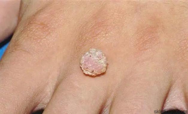 Wart Removal Treatment (Non-Genital)-SKINFUDGE