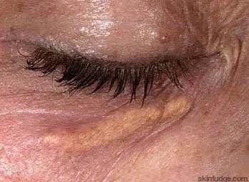 Xanthelasma (Cholesterol Patches Removal) - SKINFUDGE Aesthetics | Painless, No Side Effects, Natural Looking Results