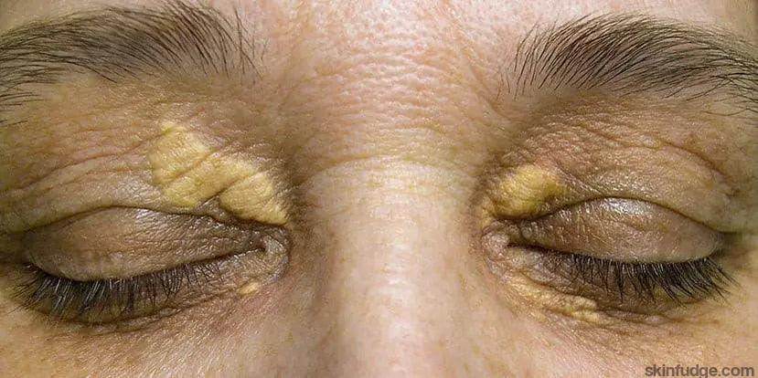 Xanthelasma (Cholesterol Patches Removal) - SKINFUDGE Aesthetics | Painless, No Side Effects, Natural Looking Results