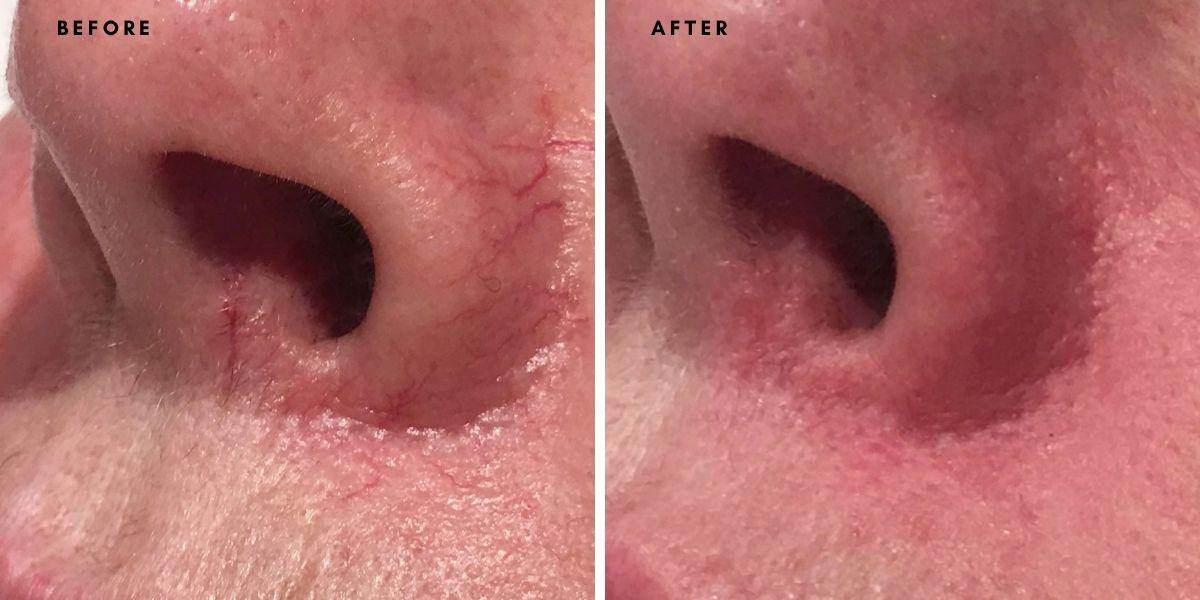 Broken Capillaries / Spider Veins Removal - SKINFUDGE Aesthetics | Painless, No Side Effects, Natural Looking Results