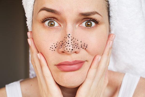 Blackhead Removal-SKINFUDGE