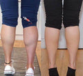 Calf Reduction Surgery - SKINFUDGE Aesthetics | Painless, No Side Effects, Natural Looking Results