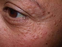 Syringoma Removal-SKINFUDGE