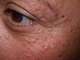 Syringoma Removal - SKINFUDGE Aesthetics | Painless, No Side Effects, Natural Looking Results