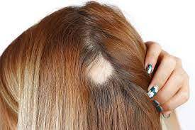 Alopecia Areata Treatment - SKINFUDGE Aesthetics | Painless, No Side Effects, Natural Looking Results