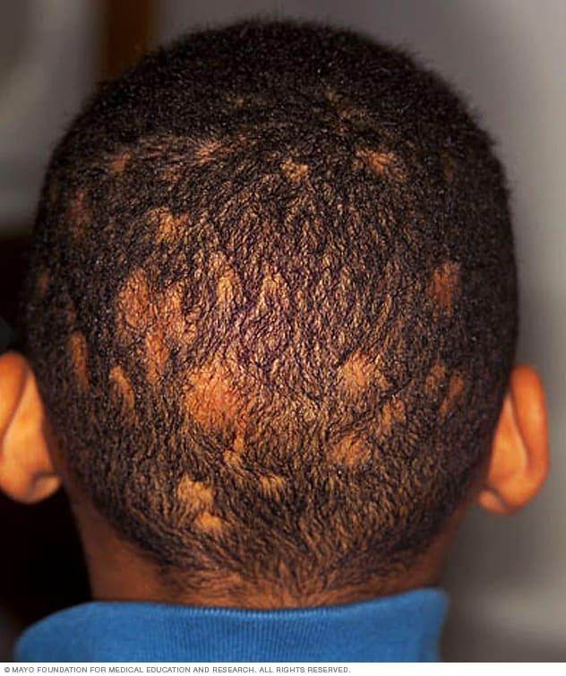 Tinea Capitis Treatment - SKINFUDGE Aesthetics | Painless, No Side Effects, Natural Looking Results