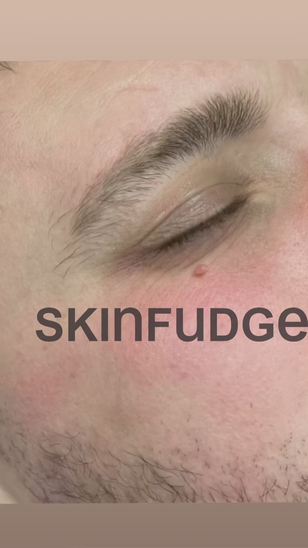 Mole Removal