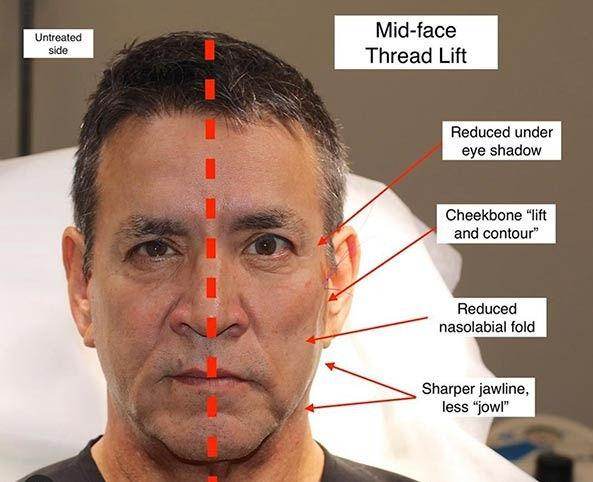 PDO Thread Lift - SKINFUDGE Aesthetics | Painless, No Side Effects, Natural Looking Results