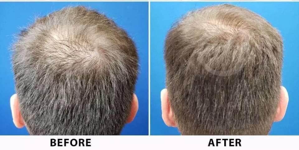 Hair Regrowth Treatment - (Dr. PRP Kit) - SKINFUDGE Aesthetics | Painless, No Side Effects, Natural Looking Results