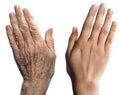 Hand Rejuvenation / Younger Looking Hands - SKINFUDGE Aesthetics | Painless, No Side Effects, Natural Looking Results