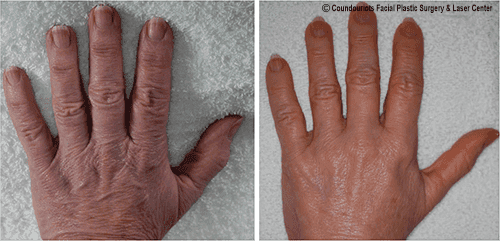 Hand Rejuvenation / Younger Looking Hands - SKINFUDGE Aesthetics | Painless, No Side Effects, Natural Looking Results