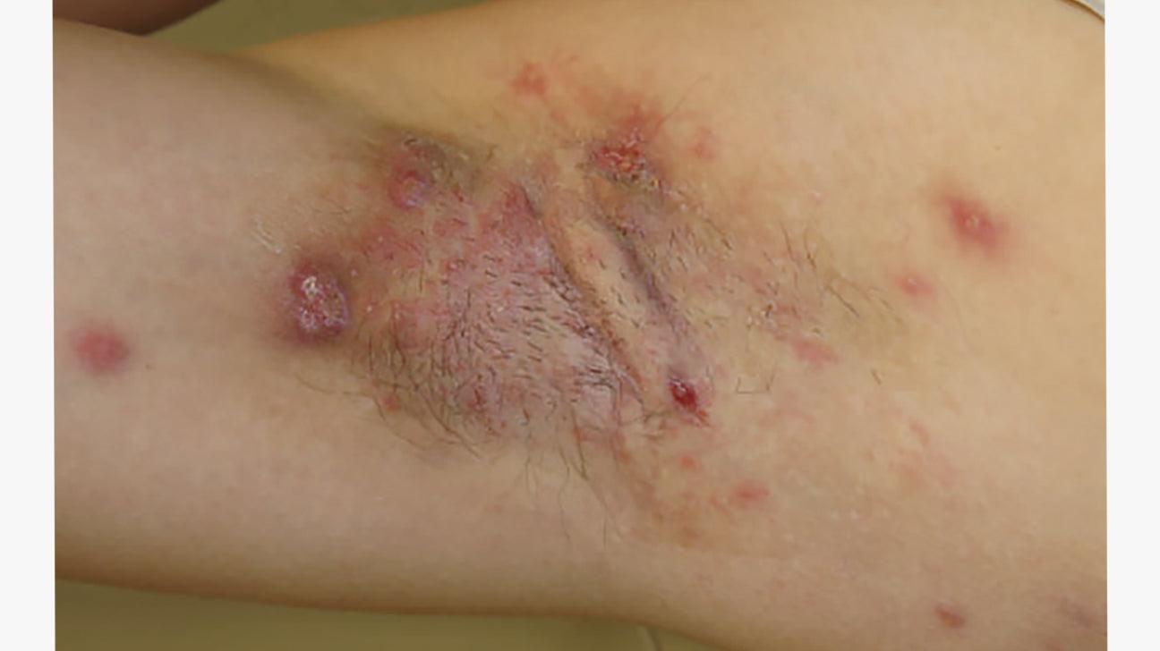 Hidradenitis Suppurativa Treatment Consultation-SKINFUDGE