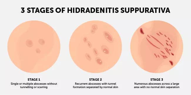 Hidradenitis Suppurativa Treatment Consultation-SKINFUDGE