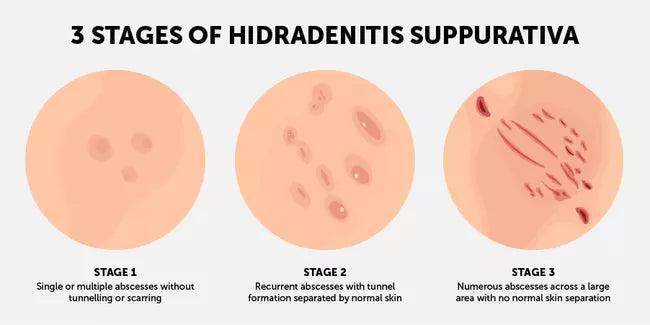 Hidradenitis Suppurativa Treatment Consultation - SKINFUDGE Aesthetics | Painless, No Side Effects, Natural Looking Results