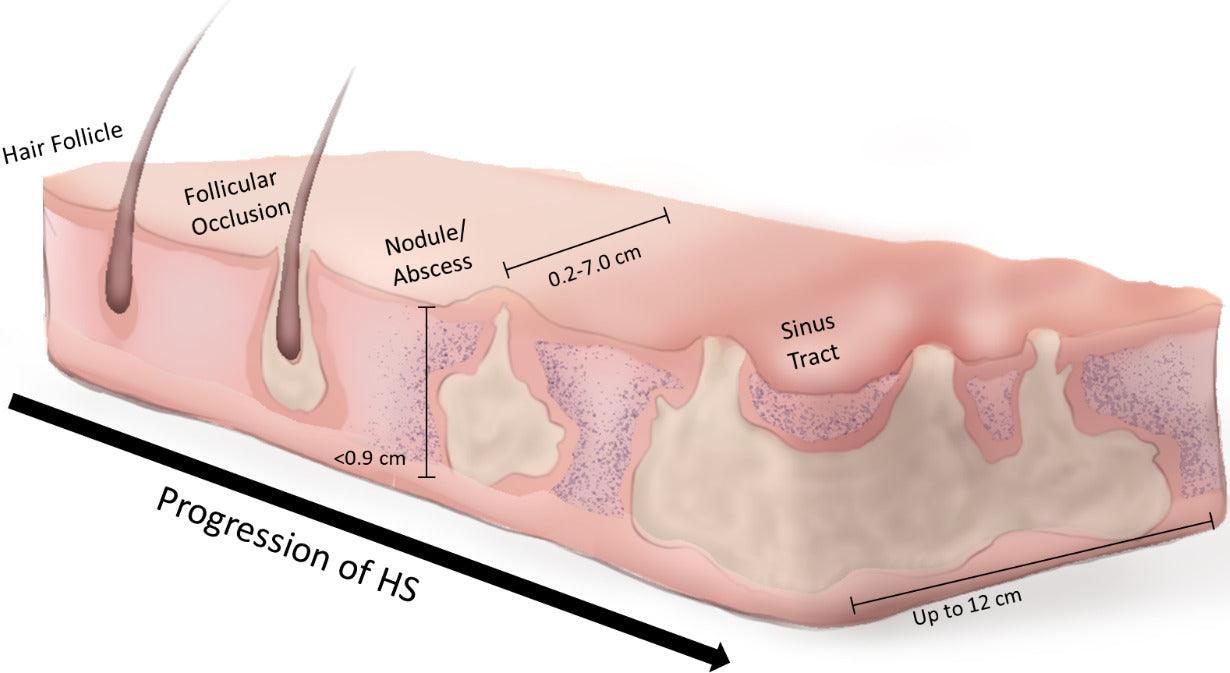 Hidradenitis Suppurativa Treatment Consultation-SKINFUDGE