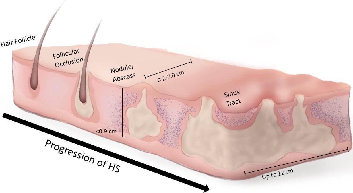 Hidradenitis Suppurativa Treatment Consultation - SKINFUDGE Aesthetics | Painless, No Side Effects, Natural Looking Results