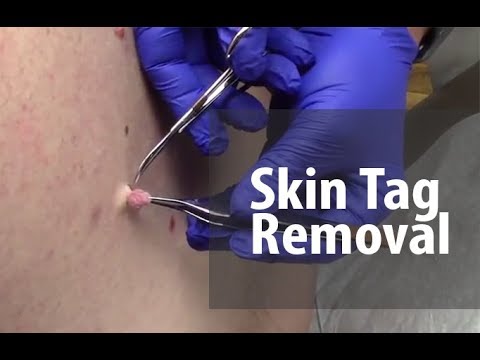 Skin Tag Removal
